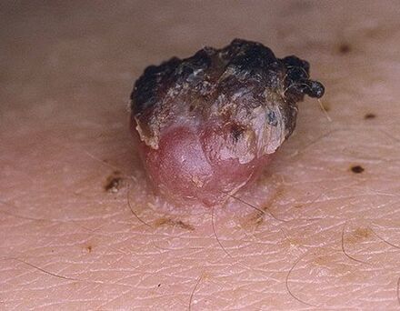 Blacked Papilloma