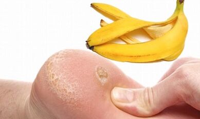 Banana Peel Landare Wart tratatzeko