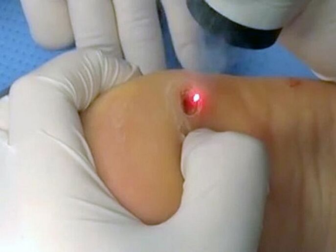garatxoen laser tratamendua