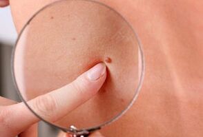 giza gorputzean papilomak agertzearen arrazoiak