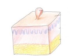 nola kentzeko papiloma gorputzean