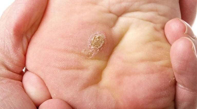 papiloma plantarrak eta lauak