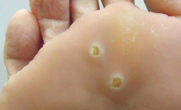 oinetako papiloma plantarrak