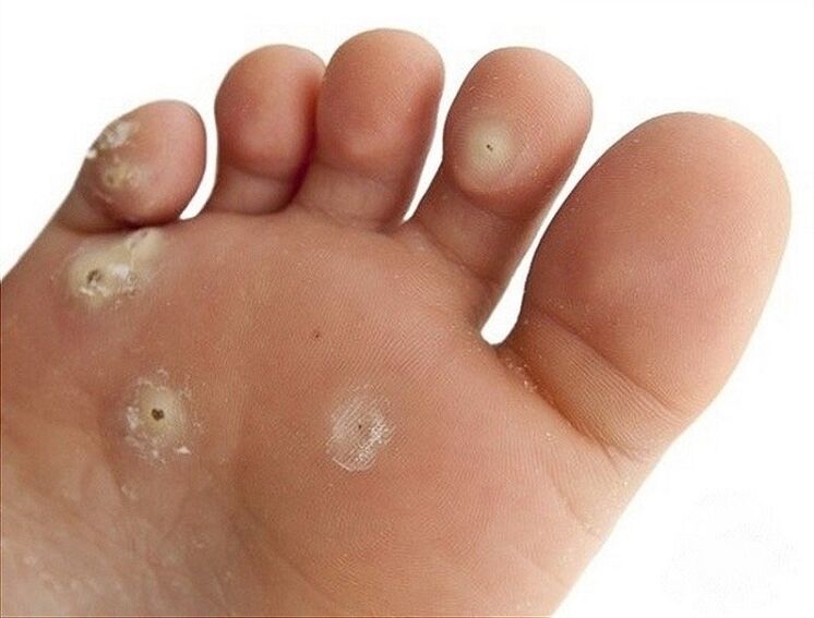 plantar garatxoa